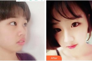 泉州海峽醫(yī)療美容醫(yī)院鄭愛(ài)萍整形價(jià)格表附超激光美膚案例展示