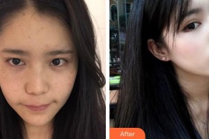 泉州海峽醫(yī)療美容醫(yī)院何春整形價(jià)格表附超激光美膚案例展示