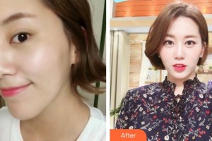 泉州歐菲醫(yī)療美容門(mén)診部鄧龍威整形價(jià)格表附超激光美膚案例展示