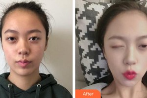 泉州康橋醫(yī)療美容門(mén)診部張迪整形價(jià)格表附熱瑪吉案例展示