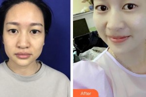 泉州億星醫(yī)療美容門(mén)診部葛海輝整形價(jià)格表附面部埋線提升案例展示