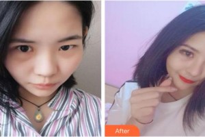 泉州歐菲醫(yī)療美容門(mén)診部王偉韜整形價(jià)格表附隆鼻案例展示