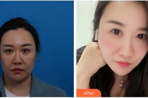 泉州歐菲醫(yī)療美容門(mén)診部韓飛整形價(jià)格表附埋線提升案例展示