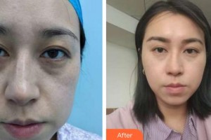 泉州歐菲醫(yī)療美容門(mén)診部林婷婷整形價(jià)格表附埋線提升案例展示