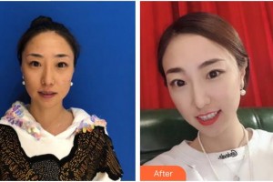 泉州歐菲醫(yī)療美容門(mén)診部劉先鋒整形價(jià)格表附多方面部埋線提升案例展示