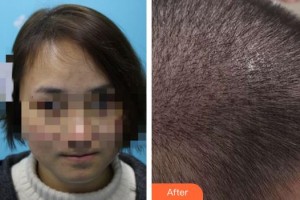 泉州歐菲醫(yī)療美容門(mén)診部夏瓊整形價(jià)格表附毛發(fā)移植案例展示