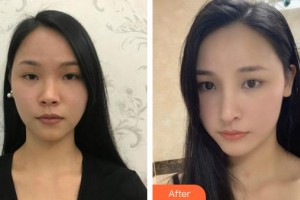 泉州美萊華美醫(yī)療美容門(mén)診部楊和強(qiáng)整形價(jià)格表附鼻部手術(shù)案例展示