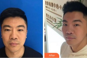 泉州維密醫(yī)療美容門(mén)診部林楦整形價(jià)格表附埋線提升案例展示