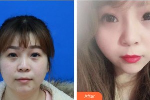 泉州美萊華美醫(yī)療美容門(mén)診部鐘豪整形價(jià)格表附埋線提升案例展示