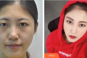 泉州美萊華美醫(yī)療美容門(mén)診部宋凡偉整形價(jià)格表附眼部綜合案例展示