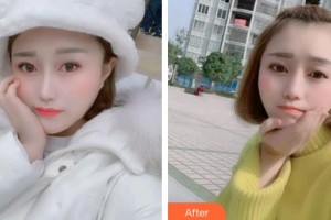 泉州泉興口腔門診部陳曉芳整形價(jià)格表附牙齒金屬矯正案例展示