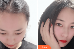 廣州雍禾植發(fā)門診部馬中林整形價(jià)格表附發(fā)際線種植案例展示