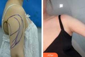 廣州法思脂肪移植醫(yī)學(xué)美容醫(yī)院胡榮軍整形價(jià)格表附手臂吸脂案例展示