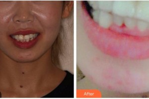 泉州貝臣口腔門診部吳東良整形價(jià)格表附瓷貼面案例展示