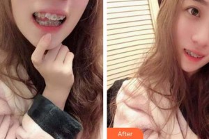 泉州貝臣口腔門診部張英整形價(jià)格表附牙齒矯正案例展示