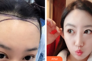 廣州雍禾植發(fā)門診部王傳凱整形價(jià)格表附發(fā)際線種植案例展示