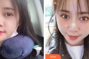 泉州貝臣口腔門診部于文英整形價(jià)格表附自鎖托槽矯正案例展示