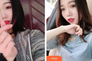 泉州維樂口腔門診部董龍福整形價(jià)格表附超聲波潔牙案例展示