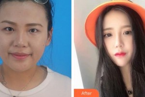 泉州愛爾眼科醫(yī)院金麗文整形價(jià)格表附眼部手術(shù)-萌系貓式電眼案例展示