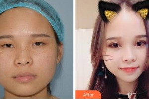 泉州愛爾眼科醫(yī)院許建斌整形價(jià)格表附雙眼皮案例展示