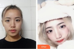 泉州愛爾眼科醫(yī)院吳松一整形價(jià)格表附切開雙眼皮案例展示