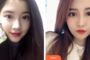 泉州愛爾眼科醫(yī)院呂帆整形價(jià)格表附眼部手術(shù)案例展示