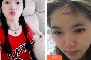 泉州愛爾眼科醫(yī)院洪英俊整形價(jià)格表附眼部綜合案例展示