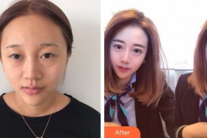 泉州愛爾眼科醫(yī)院李曉霞整形價(jià)格表附眼部綜合案例展示