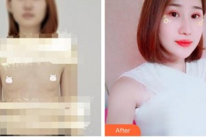 泉州星念醫(yī)療美容門診部施秀麗整形價(jià)格表附假體隆胸案例展示