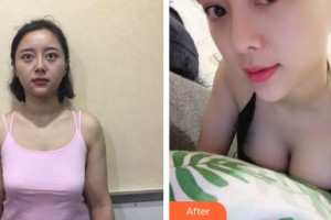 泉州脂管加醫(yī)療美容門診部吳雪玉整形價(jià)格表附隆胸案例展示