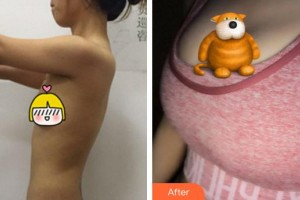 泉州脂管加醫(yī)療美容門診部林世達(dá)整形價(jià)格表附自體脂肪隆胸案例展示