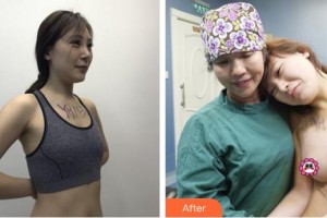 泉州脂管加醫(yī)療美容門診部楊杰整形價(jià)格表附自體脂肪隆胸案例展示