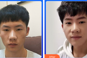 廣州博仕整形美容醫(yī)院劉洋整形價(jià)格表附切開雙眼皮案例展示