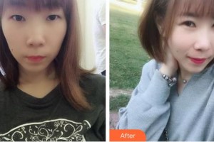 漳州市醫(yī)院整形美容科郭煒然整形價格表附切開雙眼皮案例展示