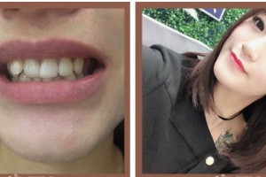 漳州佳美口腔門診部戴偉敏整形價格表附牙齒隱形矯正案例展示