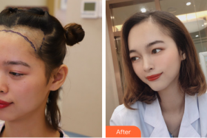 廣州雍禾植發(fā)門診部汪軍整形價(jià)格表附種植發(fā)際線案例展示