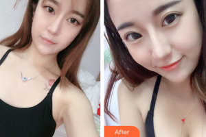 廣州伊麗莎白醫(yī)學(xué)美容門診部明皓整形價(jià)格表附自體脂肪隆胸案例展示