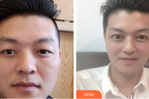 廣州博研醫(yī)療美容門診部吳良才整形價(jià)格表附切開雙眼皮案例展示