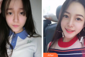 廣州藝美醫(yī)療美容門診部張濤整形價(jià)格表附雙眼皮0案例展示