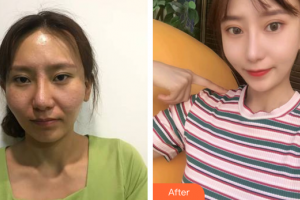 廣州拜博醫(yī)療美容門診部薛國(guó)初整形價(jià)格表附顴骨顴弓整形案例展示