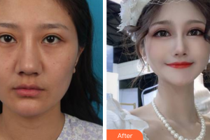 廣州柏美醫(yī)學(xué)美容醫(yī)院劉志剛整形價(jià)格表附下頜角+顴骨+下頦案例展示