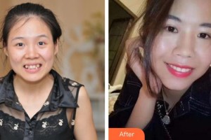 漳州佳美口腔門診部吳燕惠整形價格表附金屬托槽矯正案例展示