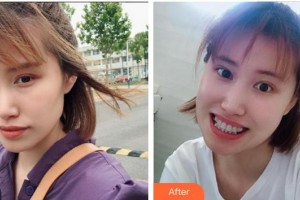 漳州佳美口腔門診部王泳洲整形價格表附金屬托槽牙齒矯正案例展示