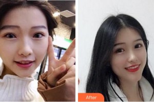 漳州佳美口腔門診部黃志達(dá)整形價格表附隱形矯正案例展示