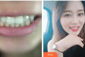 漳州佳美口腔門(mén)診部吳日耀整形價(jià)格表附金屬托槽矯正案例展示