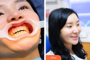 漳州佳美口腔門(mén)診部周東江整形價(jià)格表附冷光美白案例展示