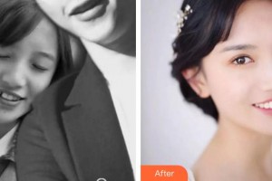 漳州佳美口腔門(mén)診部童斌斌整形價(jià)格表附金屬托槽矯正案例展示