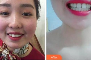 漳州衛(wèi)生職業(yè)學(xué)院附屬口腔醫(yī)院郭燦華整形價(jià)格表附隱形矯正案例展示