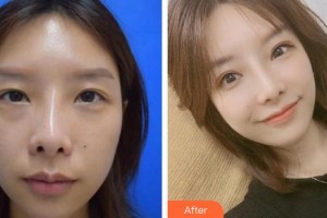 漳州柏思婭醫(yī)療美容門(mén)診部李攀整形價(jià)格表附雙眼皮修復(fù)案例案例展示