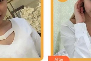 南平時(shí)光醫(yī)療美容門(mén)診部趙宏宇整形價(jià)格表附自體脂肪豐胸案例展示